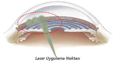 Laser Uygulaması